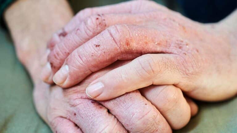 Work related skin diseases