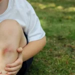 child bruise first aid
