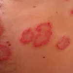 Skin Condition