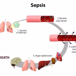 what is sepsis
